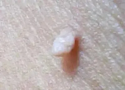 皮贅