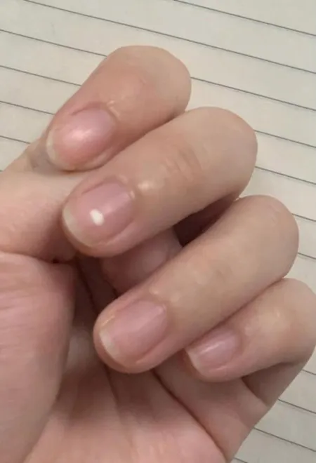 指甲出現白斑
