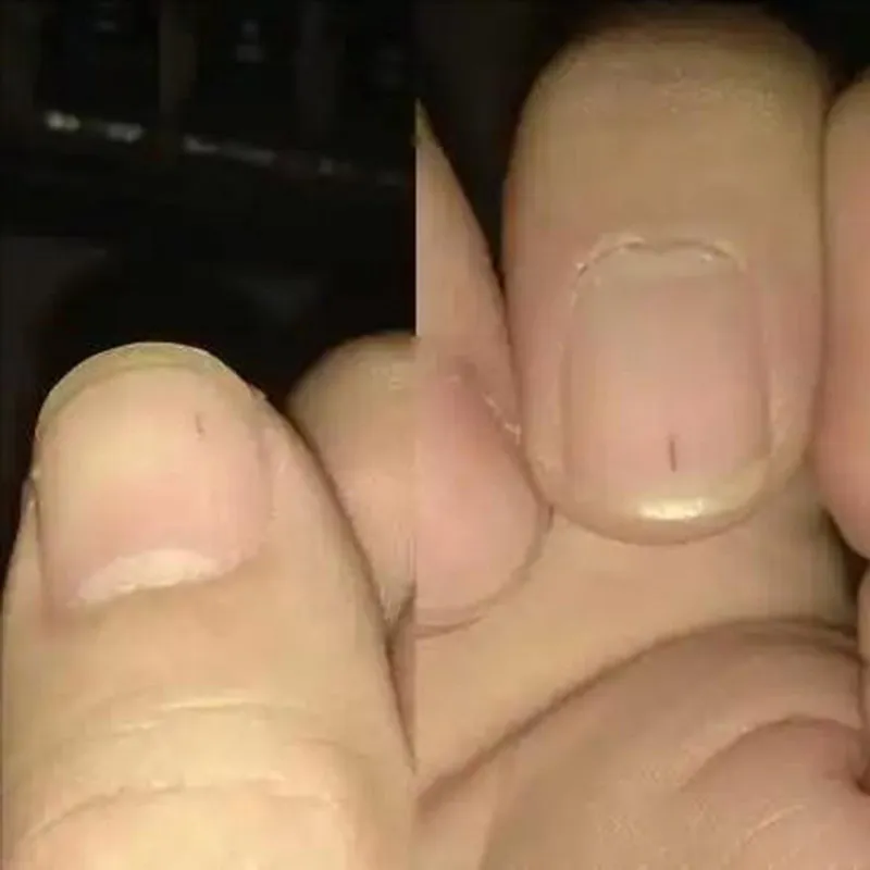 指甲出現黑線