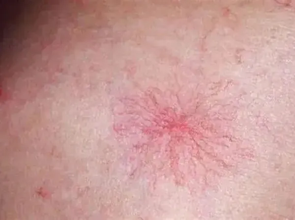 蜘蛛痣